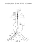 BIFURCATED ENDOVASCULAR PROSTHESIS HAVING TETHERED CONTRALATERAL LEG diagram and image