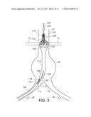 BIFURCATED ENDOVASCULAR PROSTHESIS HAVING TETHERED CONTRALATERAL LEG diagram and image