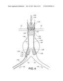 BIFURCATED ENDOVASCULAR PROSTHESIS HAVING TETHERED CONTRALATERAL LEG diagram and image