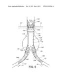 BIFURCATED ENDOVASCULAR PROSTHESIS HAVING TETHERED CONTRALATERAL LEG diagram and image