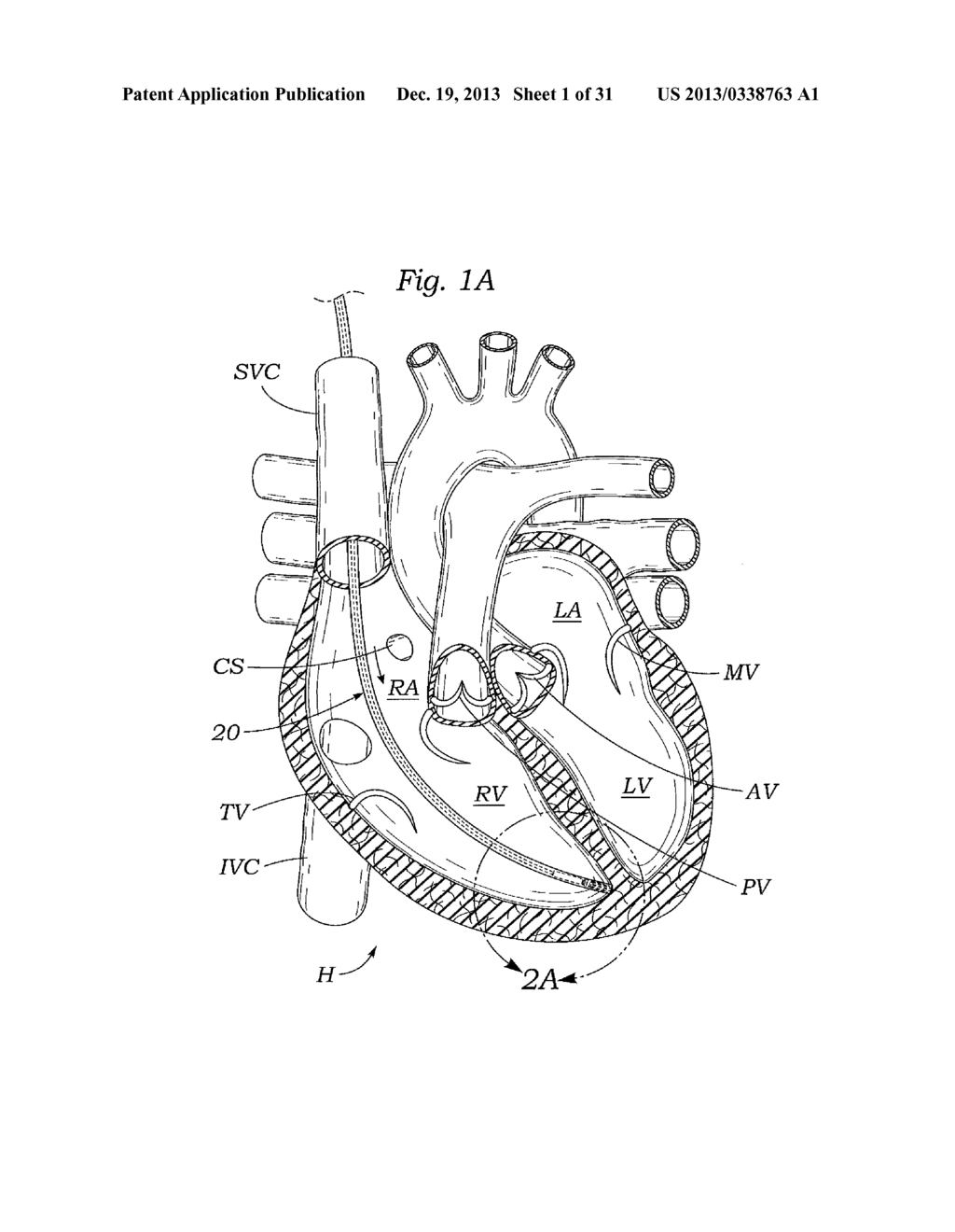 DEVICES AND METHODS FOR REDUCING CARDIAC VALVE REGURGITATION - diagram, schematic, and image 02