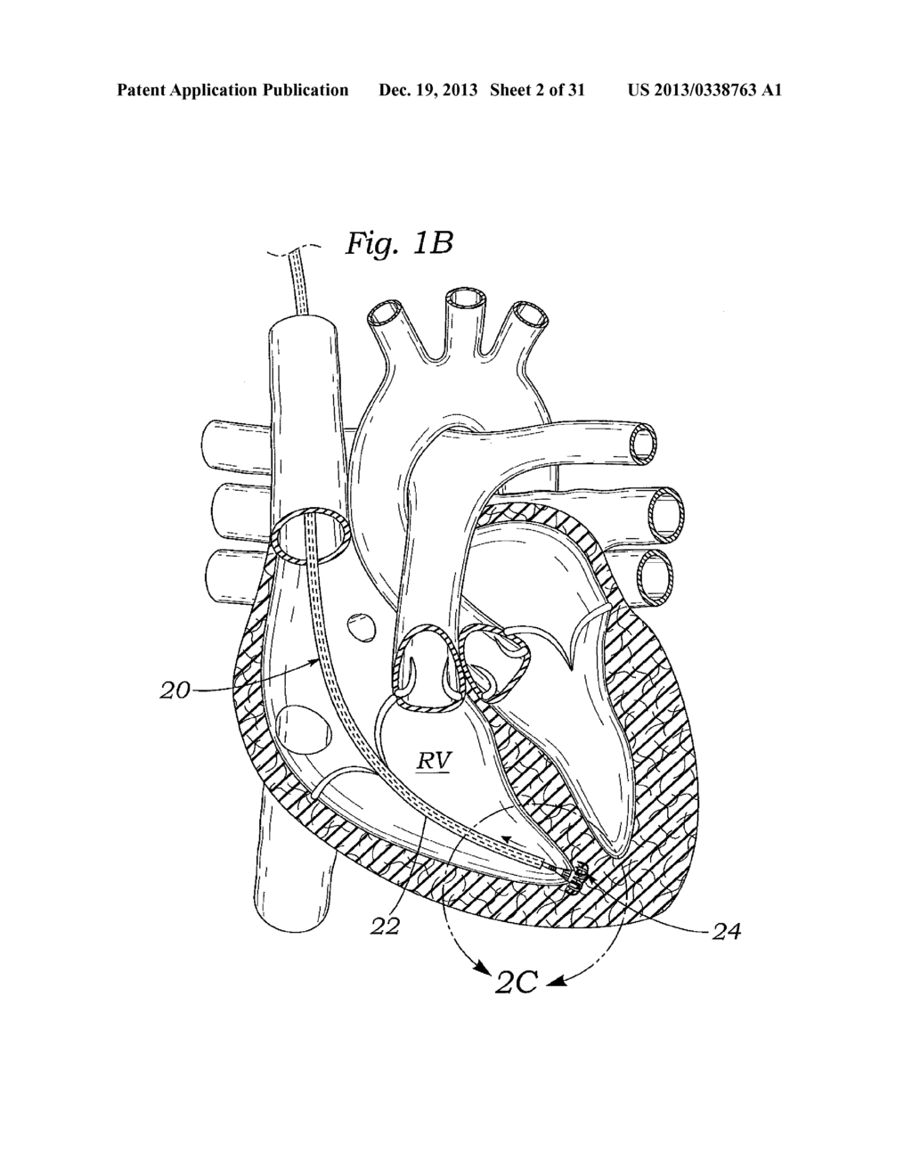 DEVICES AND METHODS FOR REDUCING CARDIAC VALVE REGURGITATION - diagram, schematic, and image 03