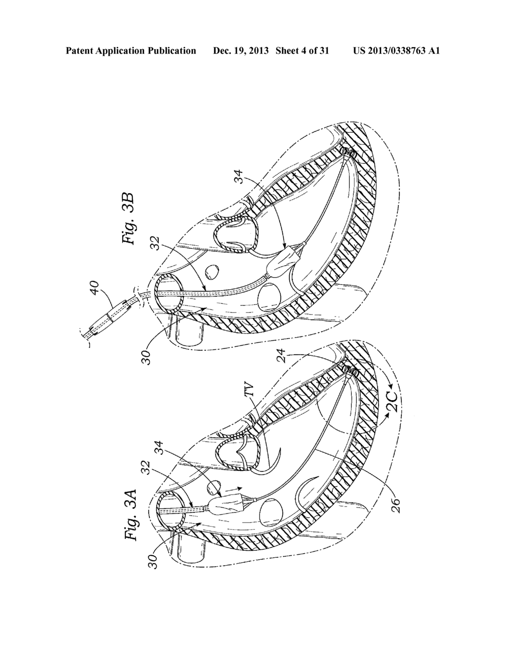 DEVICES AND METHODS FOR REDUCING CARDIAC VALVE REGURGITATION - diagram, schematic, and image 05