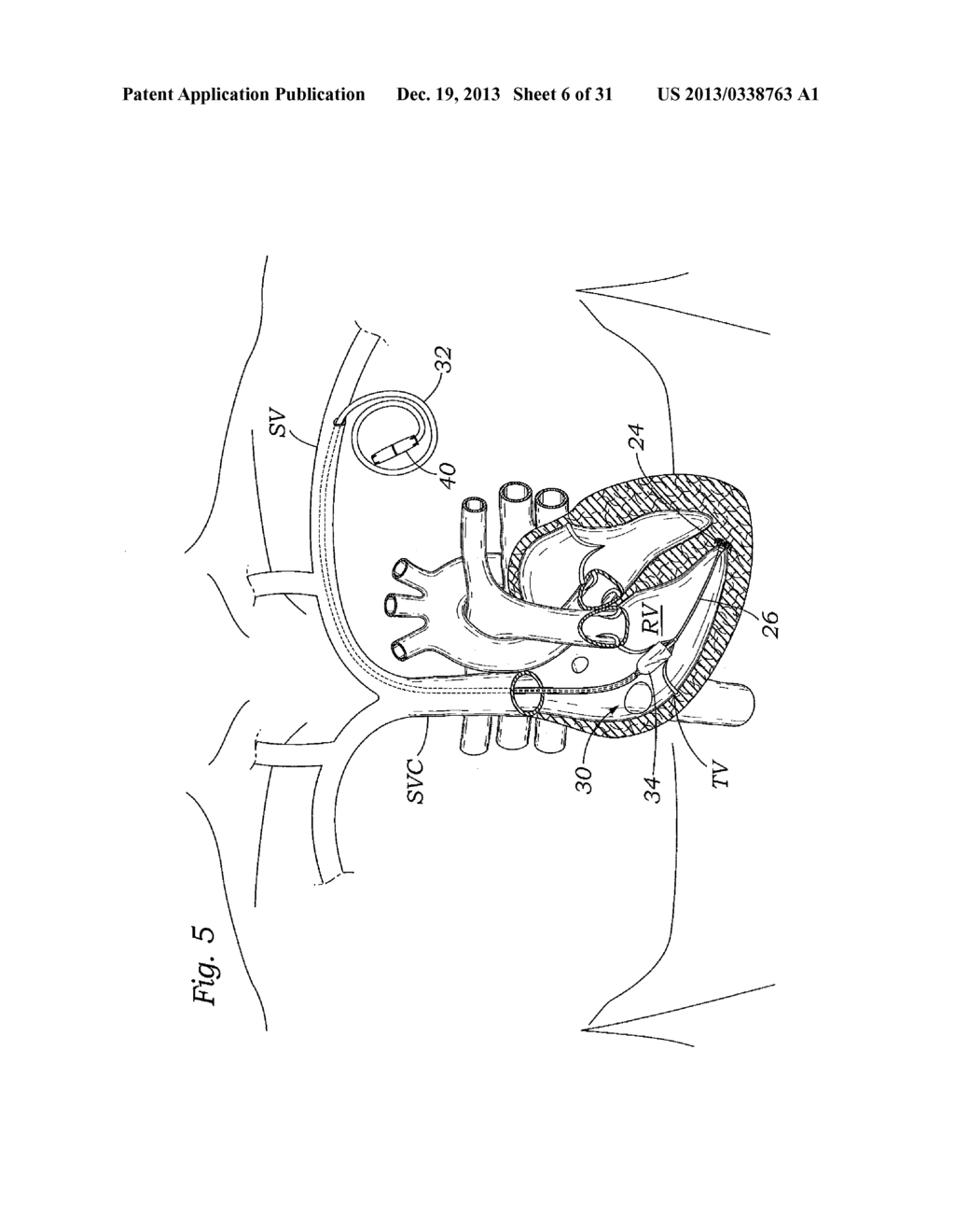 DEVICES AND METHODS FOR REDUCING CARDIAC VALVE REGURGITATION - diagram, schematic, and image 07