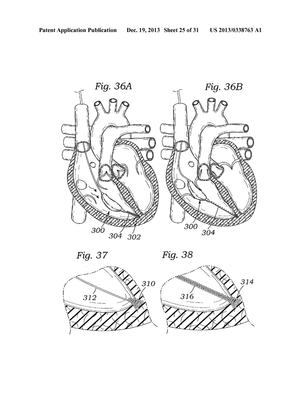 DEVICES AND METHODS FOR REDUCING CARDIAC VALVE REGURGITATION - diagram, schematic, and image 26