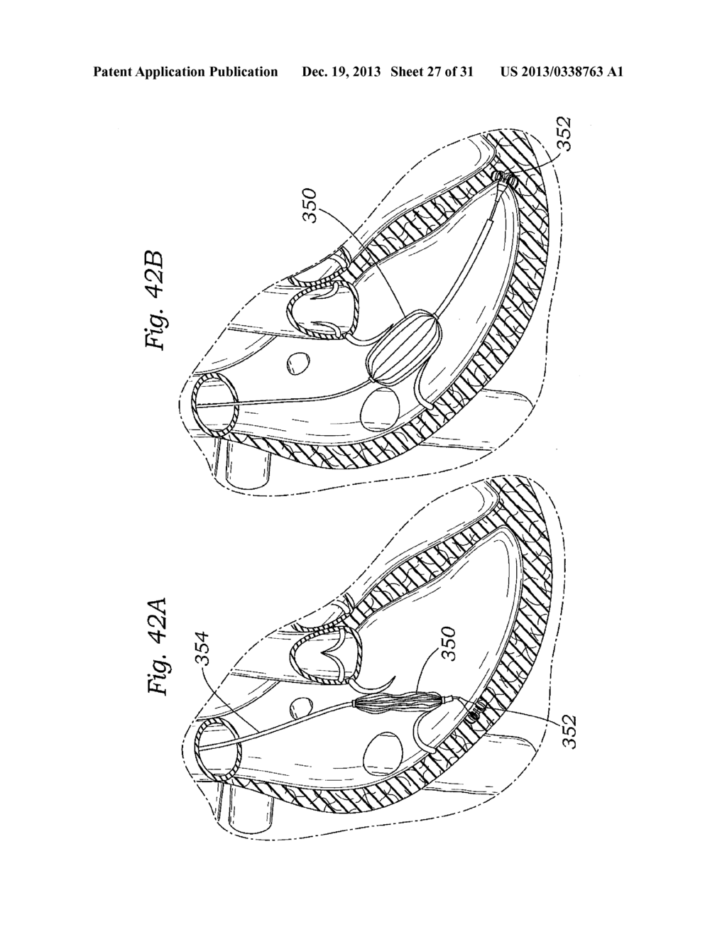 DEVICES AND METHODS FOR REDUCING CARDIAC VALVE REGURGITATION - diagram, schematic, and image 28