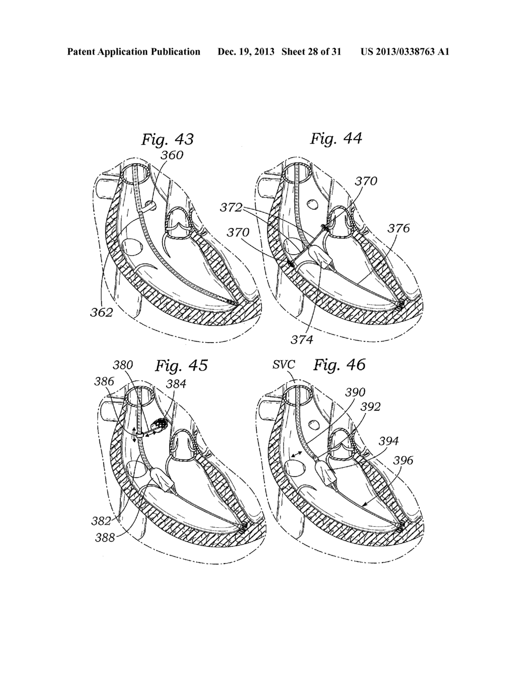 DEVICES AND METHODS FOR REDUCING CARDIAC VALVE REGURGITATION - diagram, schematic, and image 29