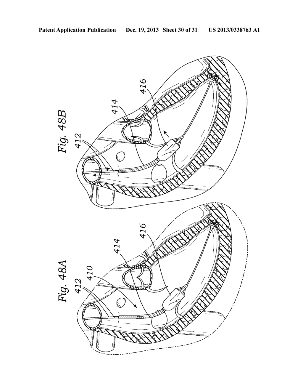 DEVICES AND METHODS FOR REDUCING CARDIAC VALVE REGURGITATION - diagram, schematic, and image 31