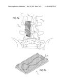 TEXTURED BONE BLOCK IMPLANTS diagram and image