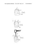 Process for securing a dental implant and dental implant diagram and image