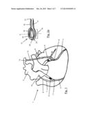 SIDE TO SIDE ANASTOMOSIS diagram and image