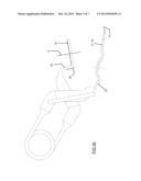 SIDE TO SIDE ANASTOMOSIS diagram and image