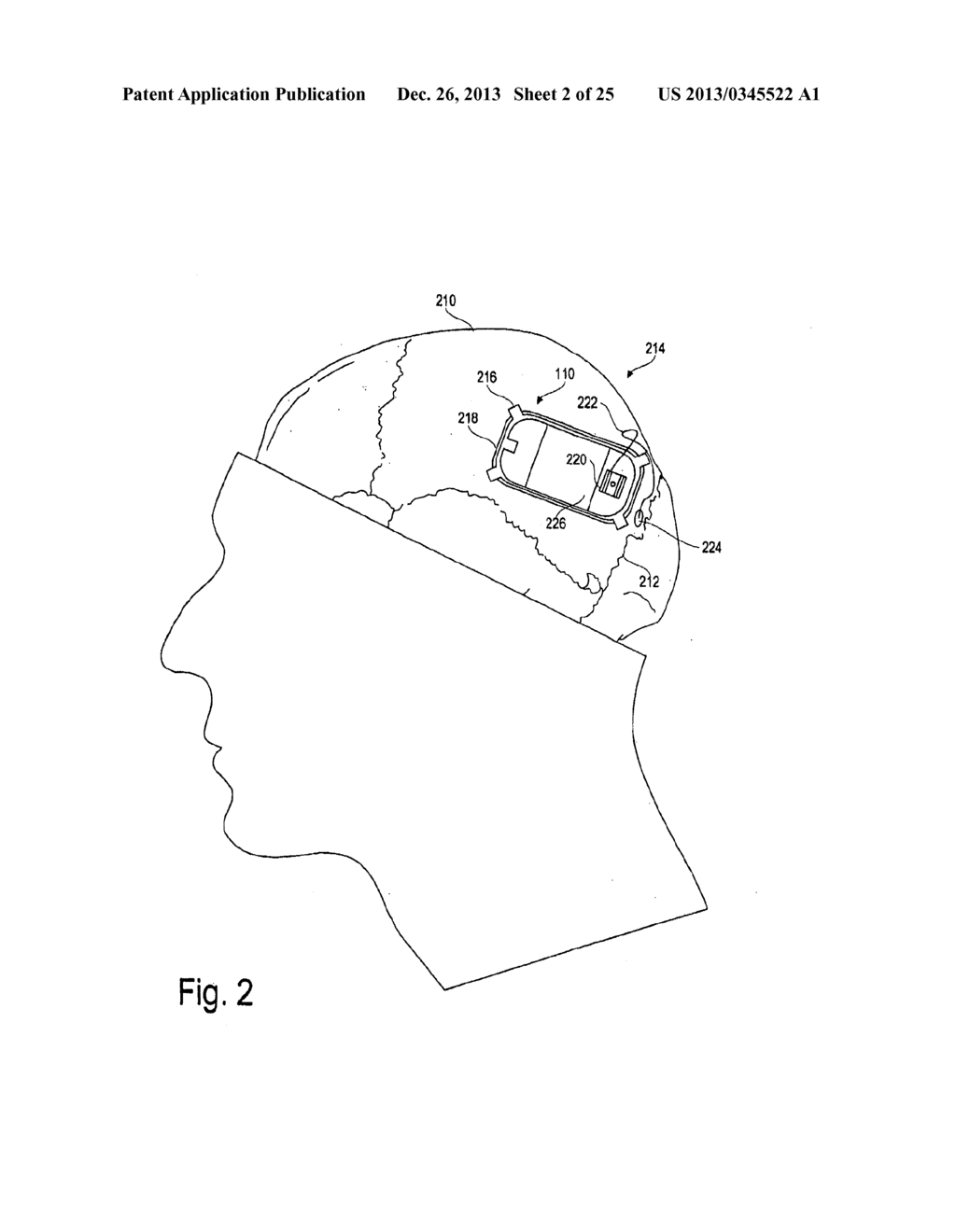 DEVICES AND METHODS FOR MONITORING PHYSIOLOGICAL INFORMATION RELATING TO     SLEEP WITH AN IMPLANTABLE DEVICE - diagram, schematic, and image 03