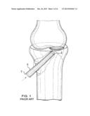 BONE TAMP APPARATUS AND METHOD diagram and image