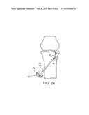 BONE TAMP APPARATUS AND METHOD diagram and image