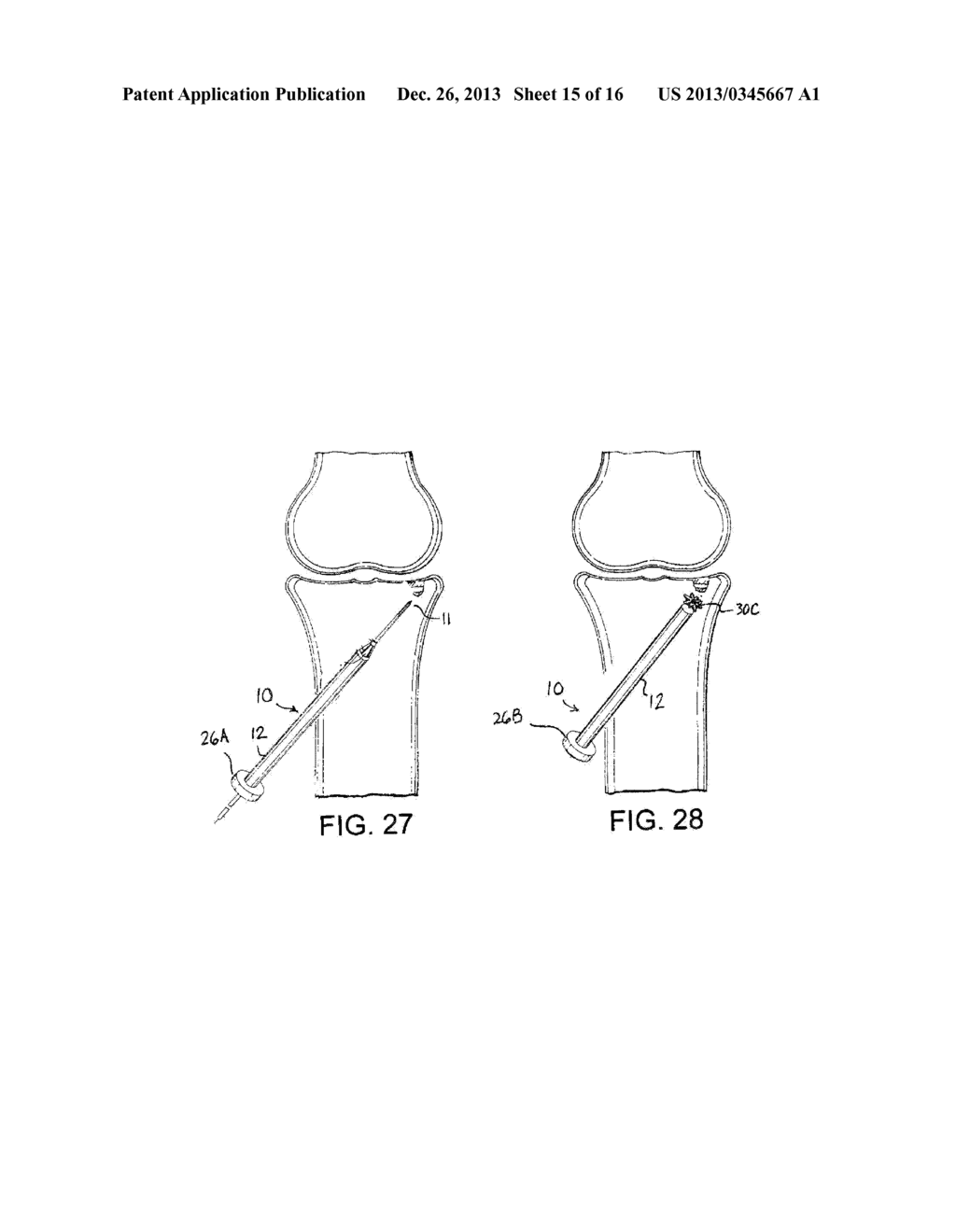 BONE TAMP APPARATUS AND METHOD - diagram, schematic, and image 16