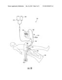 HIGH FLOW RATE ISOLATED INFUSION FOR REGIONAL TREATMENT OF CANCER AND     MEDICAL CONDITIONS diagram and image