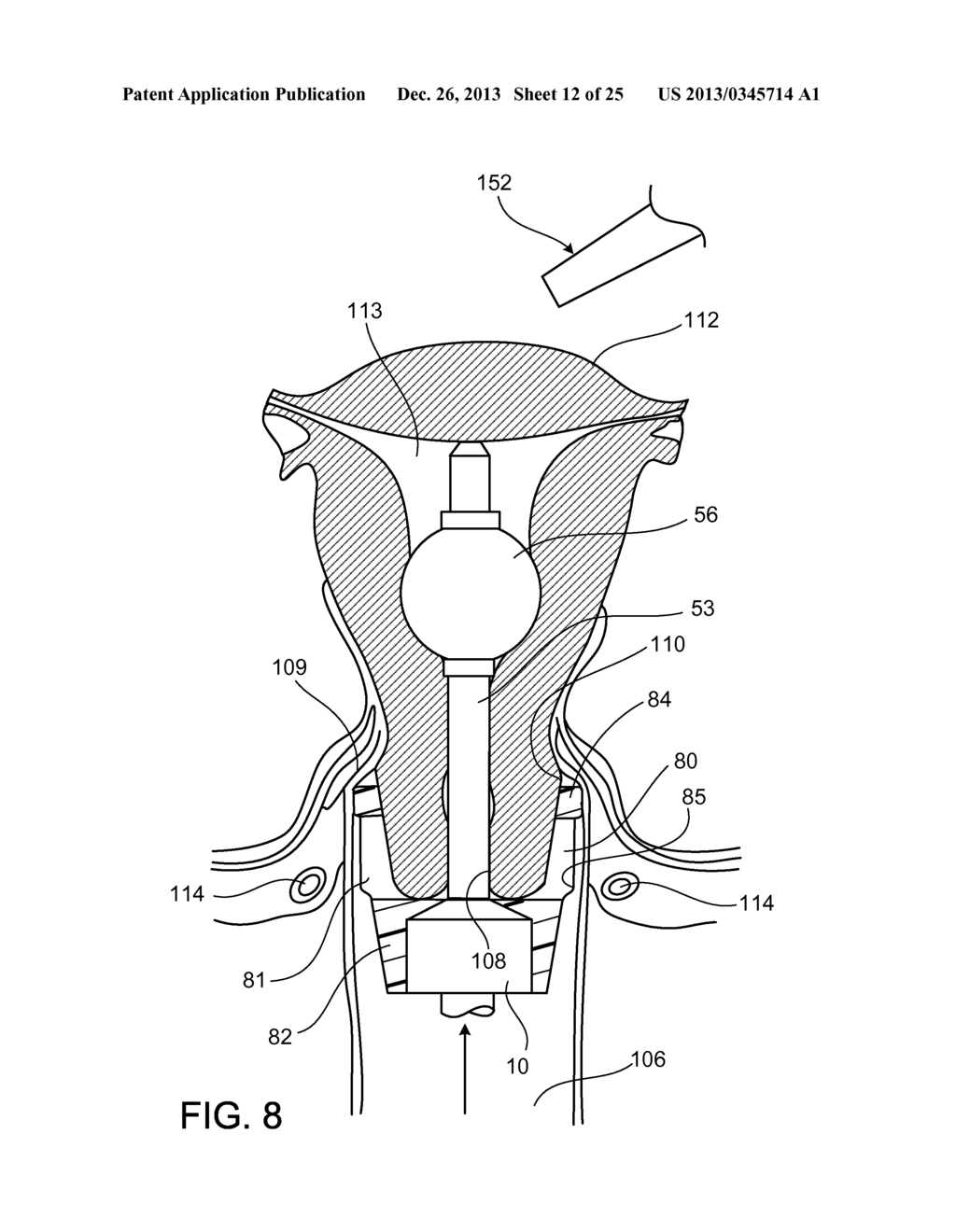 Uterine Manipulator Assemblies and Related Components and Methods - diagram, schematic, and image 13