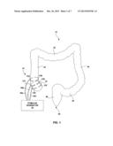 ELECTRICAL STIMULUATION OF THE COLON TO TREAT CHRONIC CONSTIPATION diagram and image