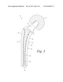 ORTHOPEDIC IMPLANT WITH POROUS POLYMER BONE CONTACTING SURFACE diagram and image