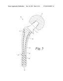 ORTHOPEDIC IMPLANT WITH POROUS POLYMER BONE CONTACTING SURFACE diagram and image