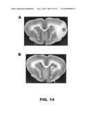 DODECAFLUOROPENTANE EMULSION AS A STROKE AND ISCHEMIA THERAPY diagram and image