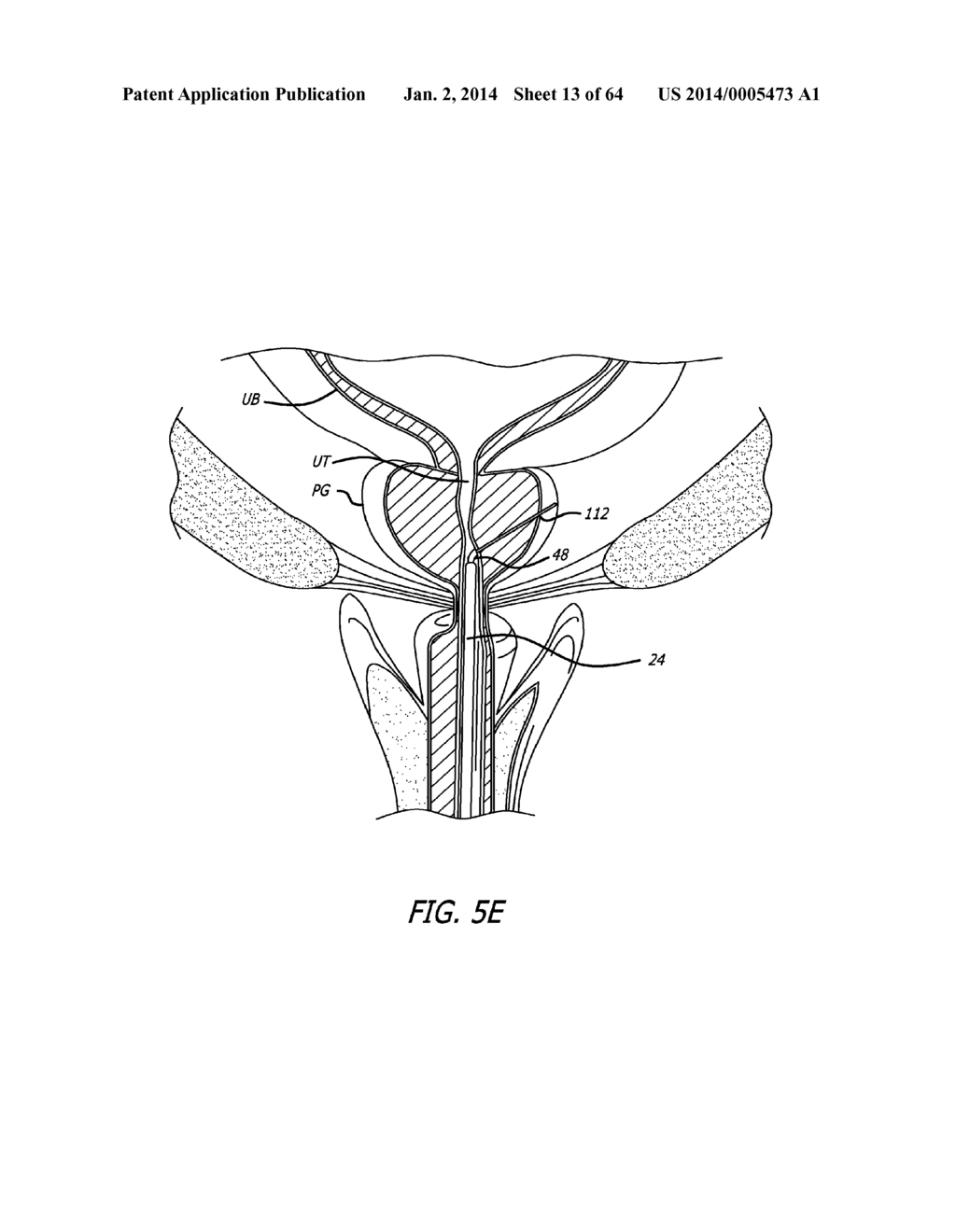 Integrated Handle Assembly for Anchor Delivery System - diagram, schematic, and image 14