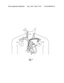 CONCURRENT THERAPY DETECTION IN IMPLANTABLE MEDICAL DEVICES diagram and image