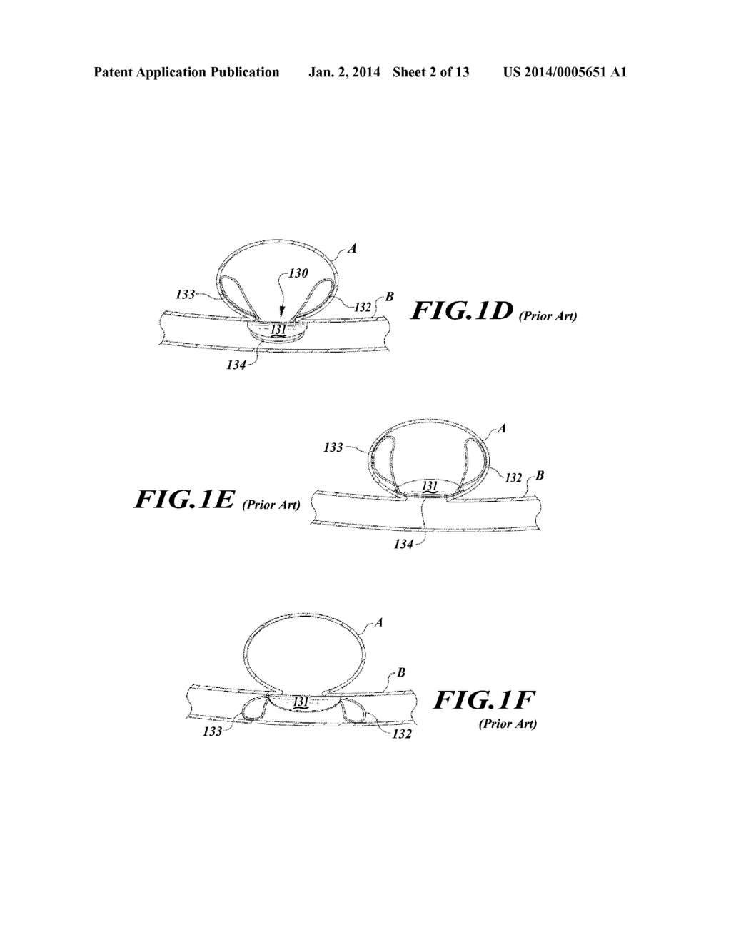 APPARATUS AND METHOD FOR POSITIONING AN IMPLANTABLE DEVICE - diagram, schematic, and image 03