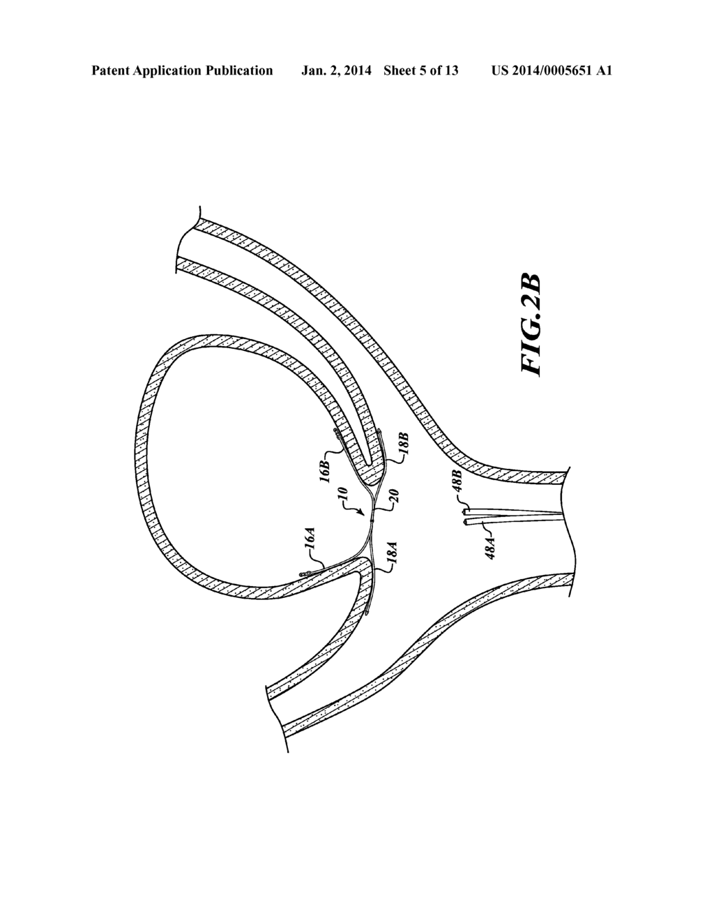 APPARATUS AND METHOD FOR POSITIONING AN IMPLANTABLE DEVICE - diagram, schematic, and image 06