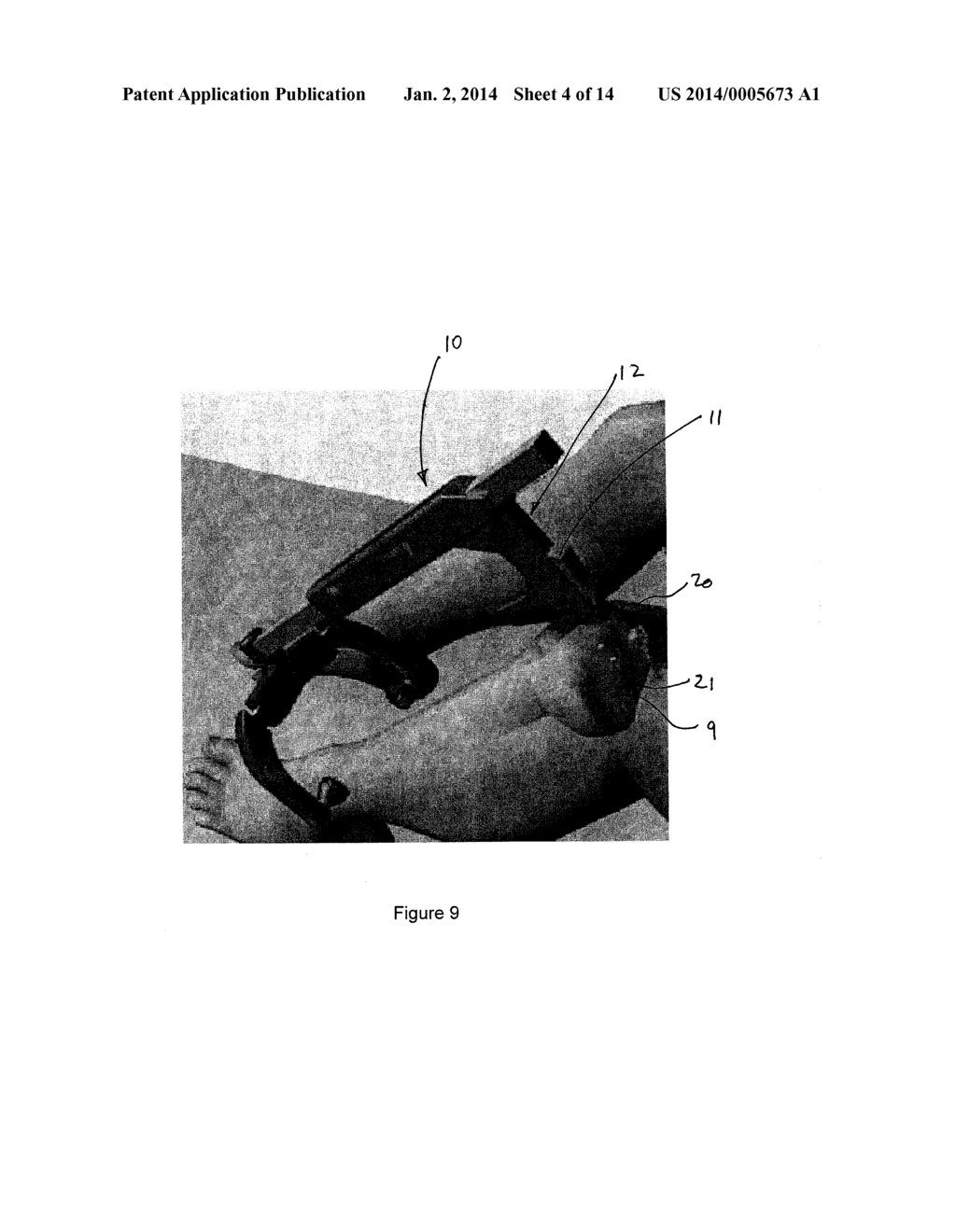 TOOL AND METHOD FOR DIGITAL ACQUISITION OF A TIBIAL MECHANICAL AXIS - diagram, schematic, and image 05