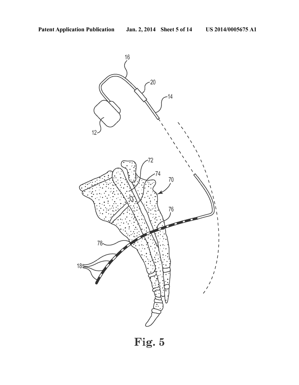 LEAD POSITIONING AND FINNED FIXATION SYSTEM - diagram, schematic, and image 06