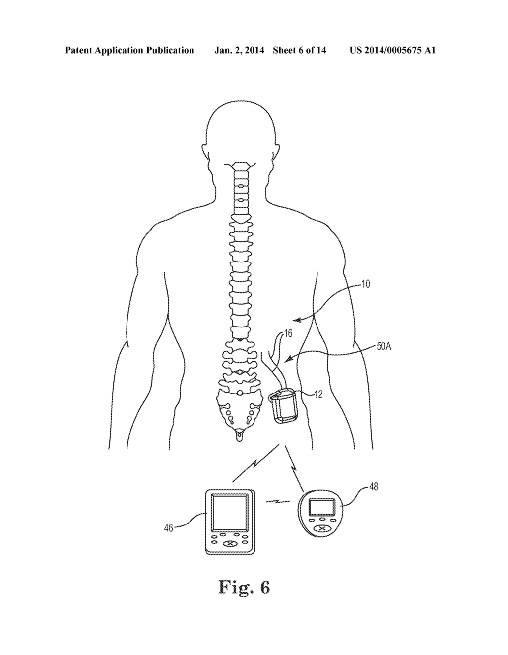 LEAD POSITIONING AND FINNED FIXATION SYSTEM - diagram, schematic, and image 07