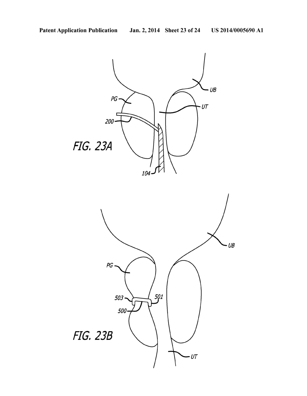 FLEXIBLE SYSTEM FOR DELIVERING AN ANCHOR - diagram, schematic, and image 24