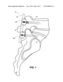 BONE SCREW COUPLING ASSEMBLY diagram and image