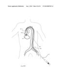 Transcatheter Heart Valve Delivery System With Reduced Area Moment of     Inertia diagram and image