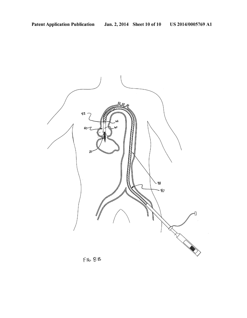 Transcatheter Heart Valve Delivery System With Reduced Area Moment of     Inertia - diagram, schematic, and image 11