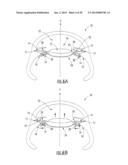 Intraocular Lens with Accommodation diagram and image