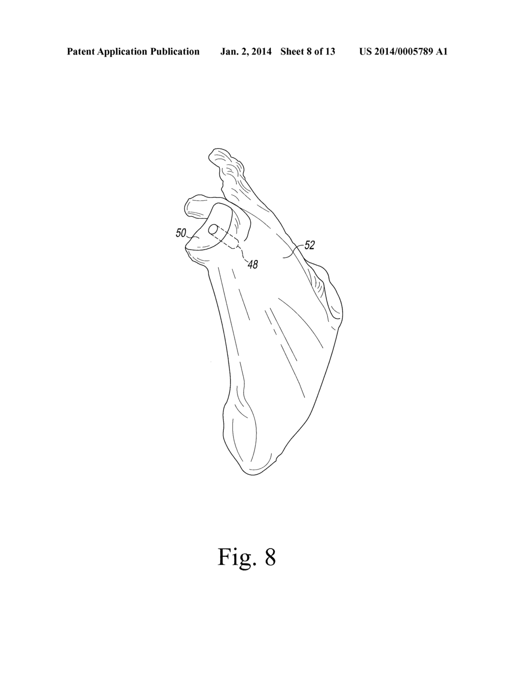 Modified Glenoid Components and Methods of Installing Same - diagram, schematic, and image 09