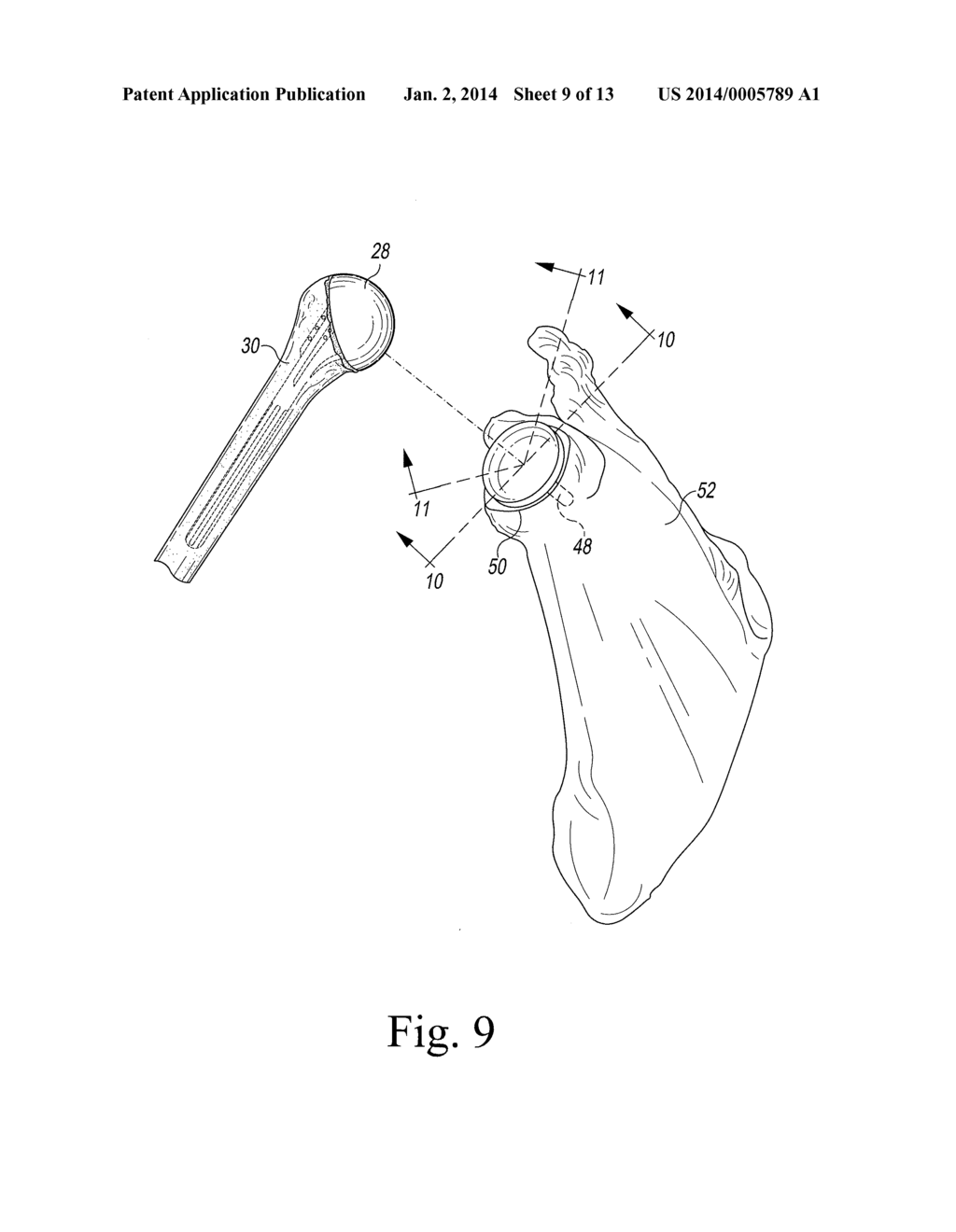 Modified Glenoid Components and Methods of Installing Same - diagram, schematic, and image 10