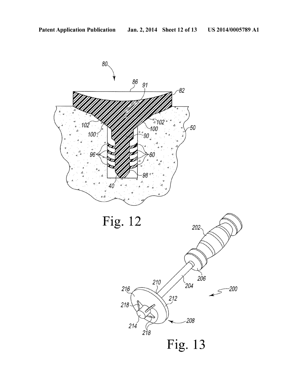 Modified Glenoid Components and Methods of Installing Same - diagram, schematic, and image 13