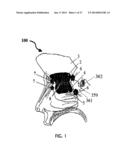 ALZHEIMER S DISEASE TREATMENT WITH MULTIPLE THERAPEUTIC AGENTS DELIVERED     TO THE OLFACTORY REGION THROUGH A SPECIAL DELIVERY CATHETER AND     IONTOPHORESIS diagram and image