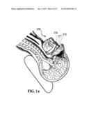 ALZHEIMER S DISEASE TREATMENT WITH MULTIPLE THERAPEUTIC AGENTS DELIVERED     TO THE OLFACTORY REGION THROUGH A SPECIAL DELIVERY CATHETER AND     IONTOPHORESIS diagram and image