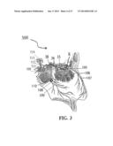 ALZHEIMER S DISEASE TREATMENT WITH MULTIPLE THERAPEUTIC AGENTS DELIVERED     TO THE OLFACTORY REGION THROUGH A SPECIAL DELIVERY CATHETER AND     IONTOPHORESIS diagram and image