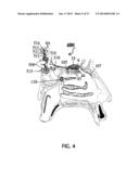 ALZHEIMER S DISEASE TREATMENT WITH MULTIPLE THERAPEUTIC AGENTS DELIVERED     TO THE OLFACTORY REGION THROUGH A SPECIAL DELIVERY CATHETER AND     IONTOPHORESIS diagram and image