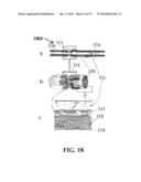 ALZHEIMER S DISEASE TREATMENT WITH MULTIPLE THERAPEUTIC AGENTS DELIVERED     TO THE OLFACTORY REGION THROUGH A SPECIAL DELIVERY CATHETER AND     IONTOPHORESIS diagram and image