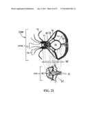 ALZHEIMER S DISEASE TREATMENT WITH MULTIPLE THERAPEUTIC AGENTS DELIVERED     TO THE OLFACTORY REGION THROUGH A SPECIAL DELIVERY CATHETER AND     IONTOPHORESIS diagram and image