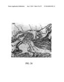 ALZHEIMER S DISEASE TREATMENT WITH MULTIPLE THERAPEUTIC AGENTS DELIVERED     TO THE OLFACTORY REGION THROUGH A SPECIAL DELIVERY CATHETER AND     IONTOPHORESIS diagram and image