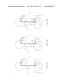 CYROGENIC TREATMENT METHODS diagram and image