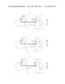 TIME-LIMITED METHODS FOR CYROGENIC TREATMENT SYSTEMS diagram and image